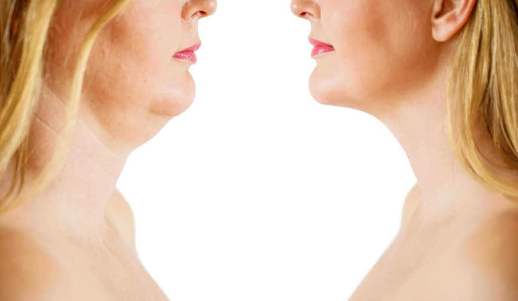 Double Chin treatment Allesley before and after results