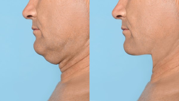 Which Non-Surgical Treatments Work Best for Jowls and Loose Skin Allesley?