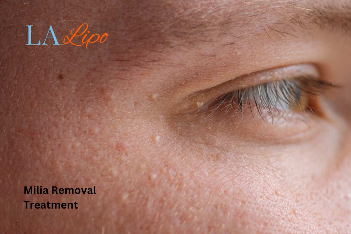 Cryopen Milia Removal: Is It the Easiest and Safest Option Allesley?
