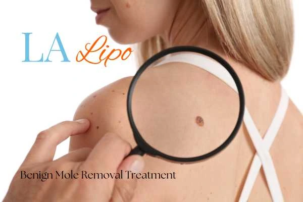 Why getting moles removed Allesley can boost your confidence!
