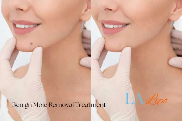 woman's before and after mole removal Allesley results