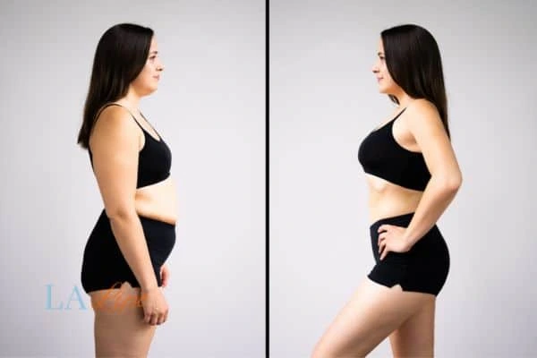 image of woman before and after results of LA-EMS Body Sculpting Allesley to help treat Diastasis recti
