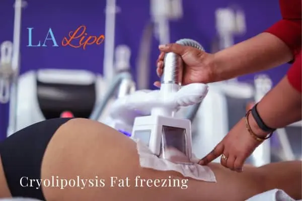 women getting fat freezing Allesley