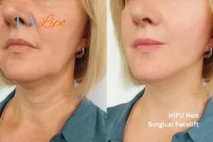 hi-fu for wrinkles Allesley before and after results