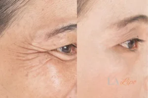 Before and after results of woman - HI-fu wrinkles reduction treatment Allesley