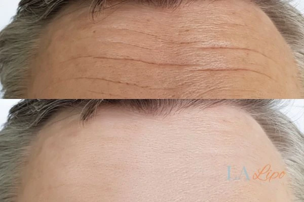 results of HIFU Allesley on mans forehead to help reduce lines and wrinkles