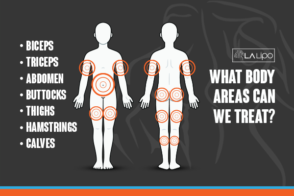 Graphic to show areas you can have LA-EMS Body Sculpting Allesley treatment.