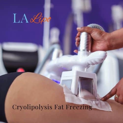 fat freezing - Cryolipolysis Allesley