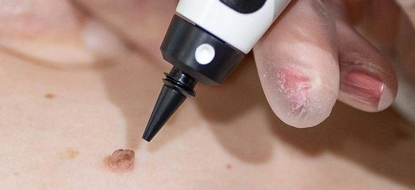 skin tag removal using cryopen Allesley
