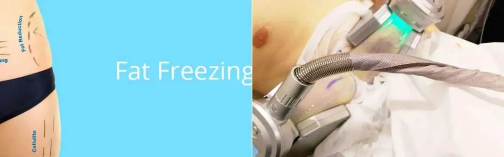 Fat freezing Allesley on multiple areas of the body