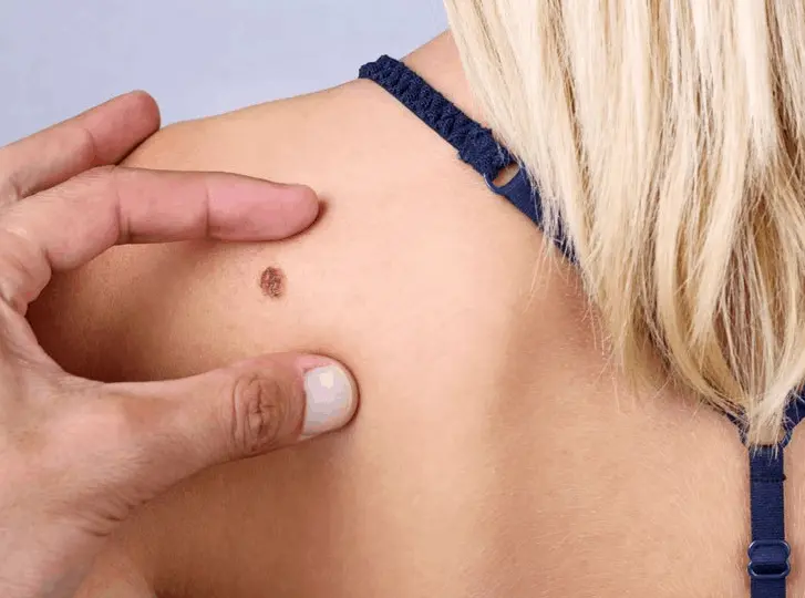 woman having mole removal Allesley consultation before treatment.