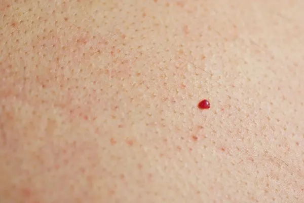 close up of a cherry angioma Allesley