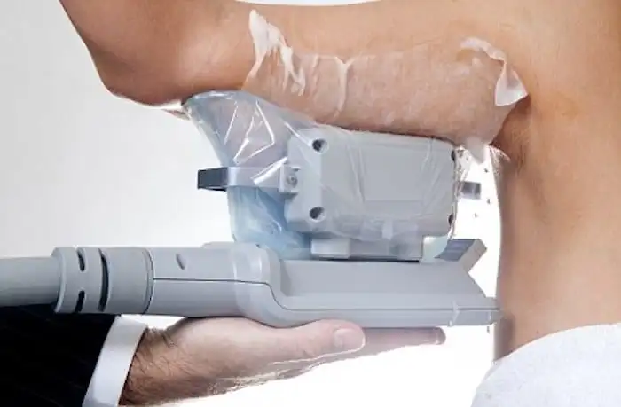Picture of fat freezing Allesley on the upper arms.