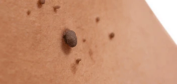image of a skin tag Allesley