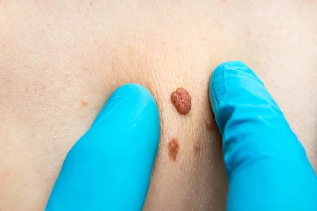 Consultant examining a skin tag Allesley