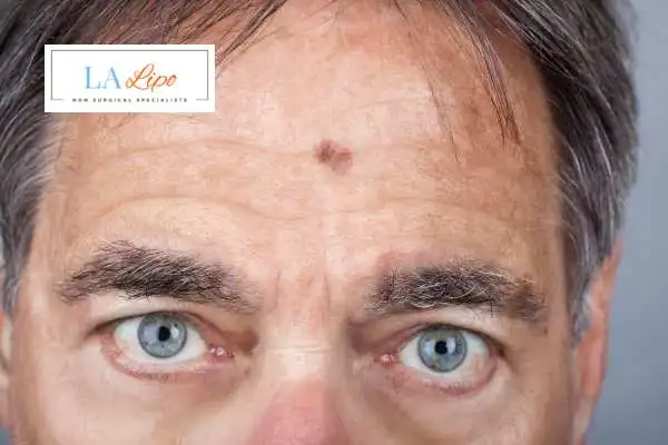 Solar Lentigo Removal Allesley image of man with mark on his forehead