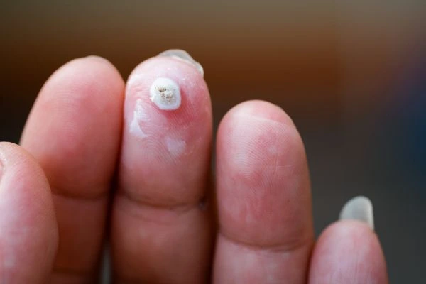 wart on person finger - cryotherapy to treat from LA LIPO Allesley