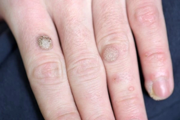 photo of warts on person hand - see wart removal Allesley from LA LIPO