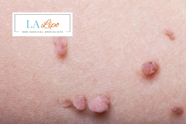 Does cryopen skin tag removal Allesley hurt? Find out now call our team today!