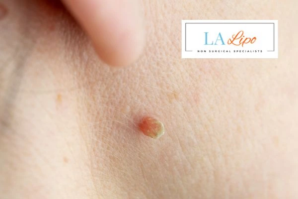 Book skin tag removal Allesley today speak to our team now!