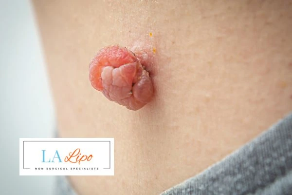 Interested in skin tag removal Allesley? Concerned about the pain? Find out more today!