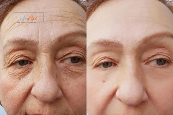 The powerful benefits of Morpheus8 Treatment Allesley - Call Our team today!