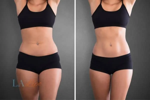 before and after results of non-surgical treatment to help a woman's body image and mental health Allesley