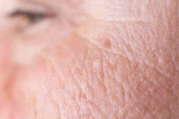 close up picture of a woman's face showing an age spot Allesley