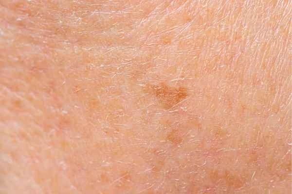 close up picture of age spots Allesley