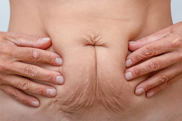 Image of a woman's stomach with loose skin - example of skin tightening Allesley options