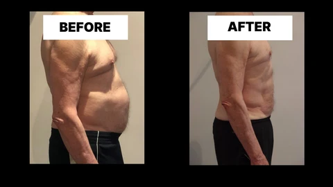 What Symptoms Can Diastasis Recti Cause in Men? Weak Core, Back Pain and Poor Posture Allesley